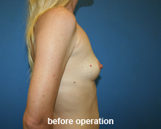 plastic-surgery-breast-augmentation